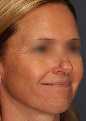 After a few microneedling treatments, my skin has really become smoother, fine lines and acne scars have been significantly improved, and my friends have said that I look younger!